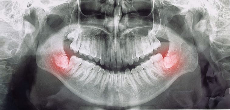 molars teeth pain